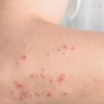 Dermatite atópica: 20% das crianças e 7% dos adultos brasileiros são impactados pela condição