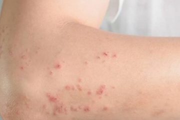 Dermatite atópica: 20% das crianças e 7% dos adultos brasileiros são impactados pela condição